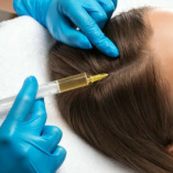 PRP Hair Loss Treatment