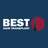 Best Hair Transplant