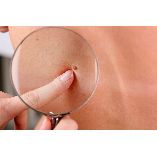 Remove Skin Tags