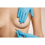 Breast Augmentation in Riyadh