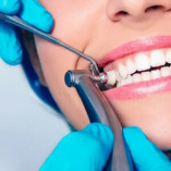 teeth cleaning in noida sector 104