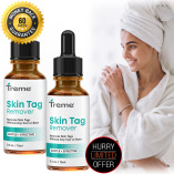 Treme Skin Tag Remover