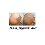 Hair Transplant Global