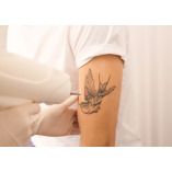 Rimozione Tatuaggi