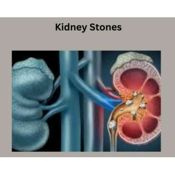 Kidney Stones Reviews & Experiences