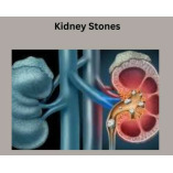 Kidney Stones