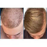 Hair Transplant Surgery