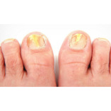 Treat Toenail Fungus Naturally At Home