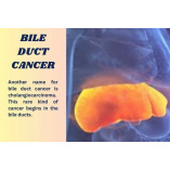 BILE DUCT CANCER TREATMENT IN INDIA