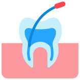 root-canal-treatment-in-vijayawada