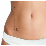 Liposuction in Riyadh