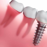 Dental Implant