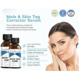 Charm Health Skin Tag Remover Experience